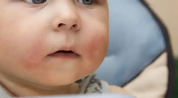 Czerwone policzki u niemowlaka mogą być jednym z objawów nietolerancji glutenu.